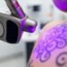 tattoo removal solutions